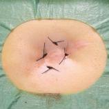 Sutures gastropexy